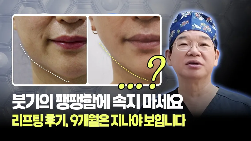 리프팅시술 9개월 후, 붓기 아닌 진짜 라인 공개 | 복합시술 + 줄기세포 | 보니따의원 리프팅